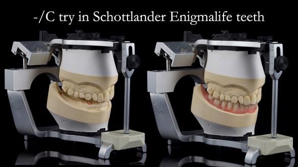 Newsletter 44 - extreme removable prosthodontics – engineering a super-strong and ultra-thin over denture