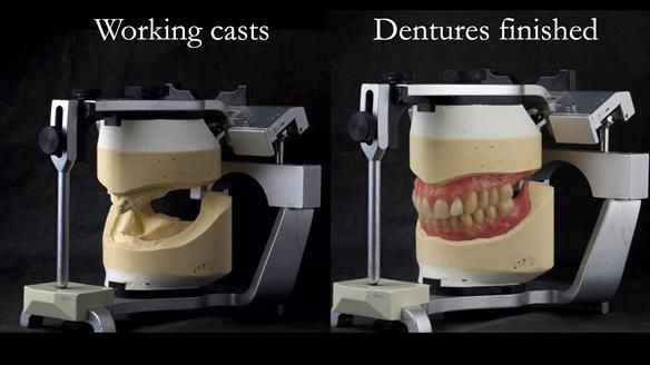 Newsletter 74: Ken’s Case Study Complete Dentures - Life Like and Age Appropriate