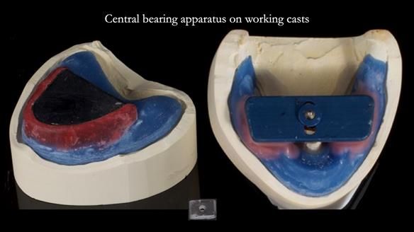 Newsletter 68 Restoring Jan’s Smile: Complete Dentures Inspired by Her Daughter’s Teeth - Post Mouth Surgery