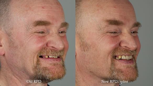 How Keith’s combat denture transformed his life – Newsletter 73