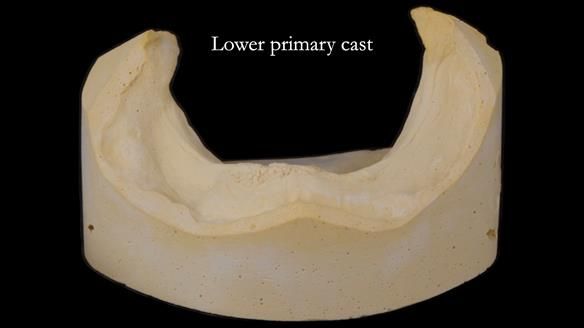 Newsletter 74: Ken’s Case Study Complete Dentures - Life Like and Age Appropriate