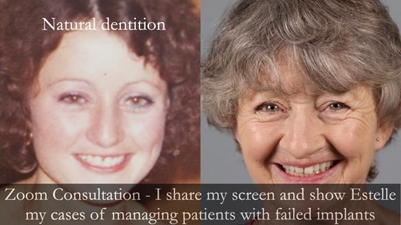 Newsletter 49 Managing Estelle’s failing implants with dentures FULL PROTOCOL