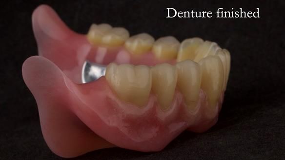 Newsletter 74: Ken’s Case Study Complete Dentures - Life Like and Age Appropriate