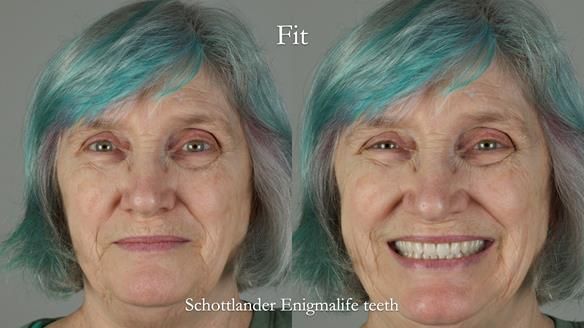 Newsletter 70 Complete Denture Treatment for Kate: A Case Study on Natural-Looking Dentures and Implant-Supported Overdentures