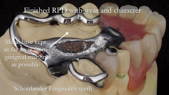 Eileen's transformation with upper and lower RPDs of Scandinavian hygienic design FULL PROTOCOL