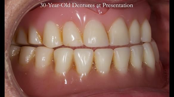 Newsletter 68 Restoring Jan’s Smile: Complete Dentures Inspired by Her Daughter’s Teeth - Post Mouth Surgery