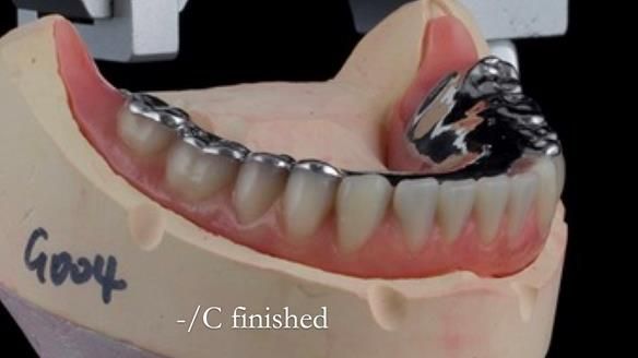 Newsletter 44 - extreme removable prosthodontics – engineering a super-strong and ultra-thin over denture