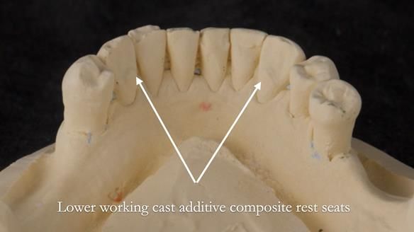 Solving Linda’s Failed “All on 4” implant bridges - full protocol Newsletter 42