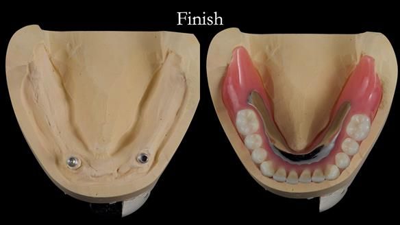 Newsletter 49 Managing Estelle’s failing implants with dentures FULL PROTOCOL