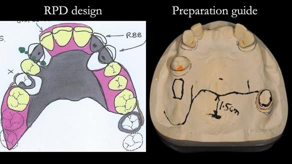 Managing Edgar “THE SCEPTIC” with an RPD/Splint FULL CASE