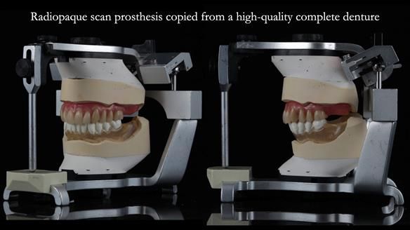 Newsletter 70 Complete Denture Treatment for Kate: A Case Study on Natural-Looking Dentures and Implant-Supported Overdentures