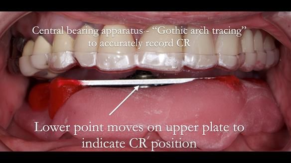 Newsletter 44 - extreme removable prosthodontics – engineering a super-strong and ultra-thin over denture