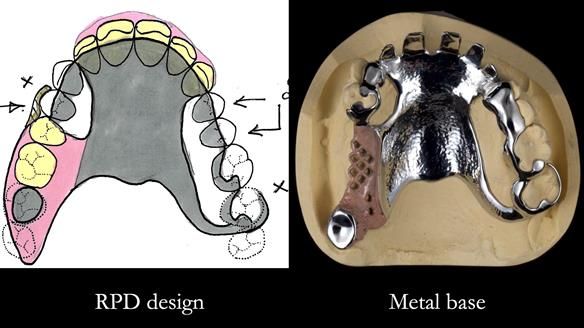 How Keith’s combat denture transformed his life – Newsletter 73