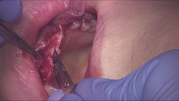 Figure 28 Thinning the incsial papilla and palatal tissues with number 15 blade