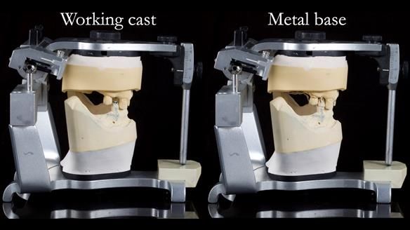 Managing Edgar “THE SCEPTIC” with an RPD/Splint FULL CASE