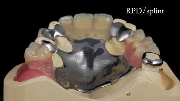 Managing Edgar “THE SCEPTIC” with an RPD/Splint FULL CASE