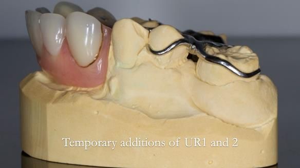 Eileen's transformation with upper and lower RPDs of Scandinavian hygienic design FULL PROTOCOL