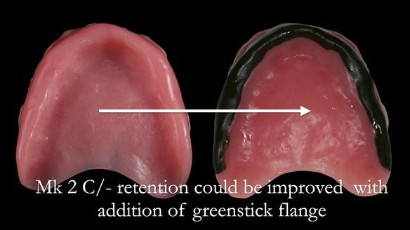 Replacing Madeline’s Complete denture FULL PROTOCOL