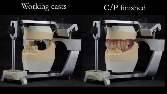 Solving Linda’s Failed “All on 4” implant bridges - full protocol Newsletter 42