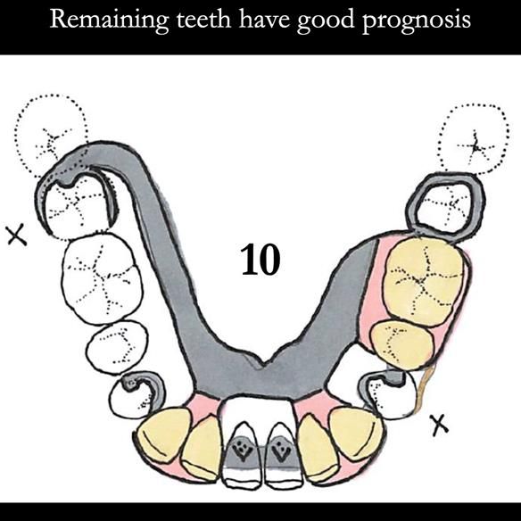 Universal Scandinavian partial denture designs