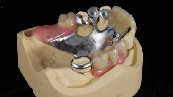 Managing Edgar “THE SCEPTIC” with an RPD/Splint FULL CASE