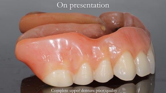 Newsletter 65 Marisa Provision of Complete Dentures on badly placed implants