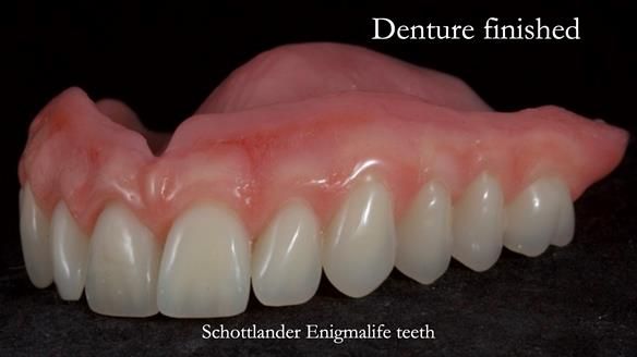 Newsletter 70 Complete Denture Treatment for Kate: A Case Study on Natural-Looking Dentures and Implant-Supported Overdentures