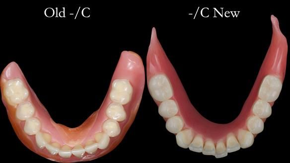 Replacing Madeline’s Complete denture FULL PROTOCOL