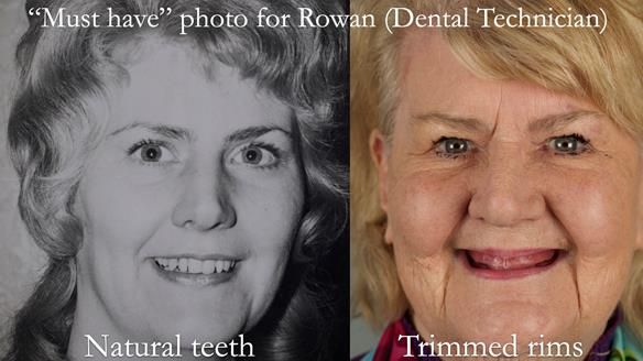 Replacing Madeline’s Complete denture FULL PROTOCOL