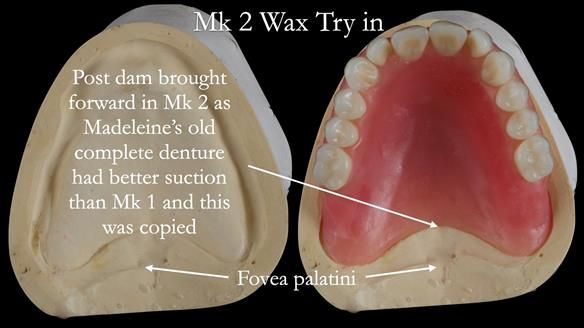 Replacing Madeline’s Complete denture FULL PROTOCOL