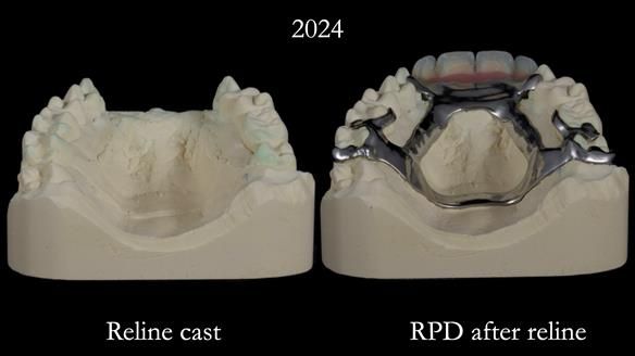 Newsletter 66 Long term case study. Life changing metal based RPD made for Anna