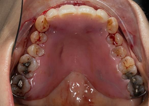 Figure 34 Once adjusted the denture seated correctly around the teeth as it does on the cast in figure 23