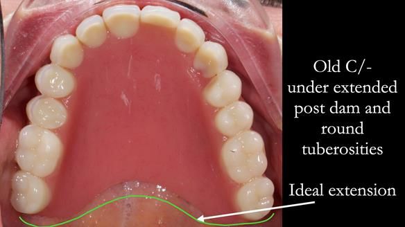 Solving Linda’s Failed “All on 4” implant bridges - full protocol Newsletter 42