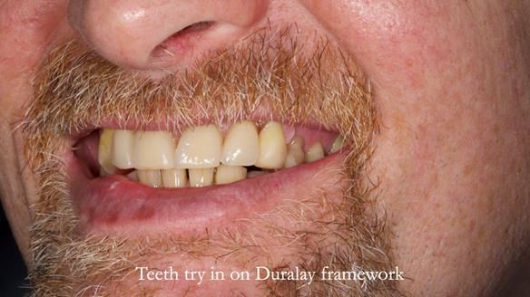 How Keith’s combat denture transformed his life – Newsletter 73