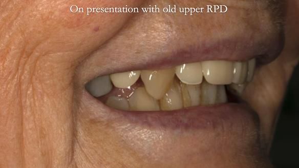 Newsletter 71 Jean’s Class I Mod III RPD: See my mistakes Fractured Mk1 to a Stronger Mk2 RPD (4 years on)