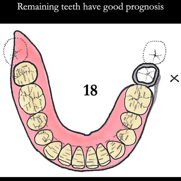 Universal Scandinavian partial denture designs