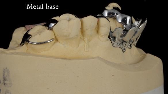 How Keith’s combat denture transformed his life – Newsletter 73