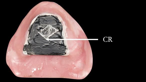 Solving Linda’s Failed “All on 4” implant bridges - full protocol Newsletter 42