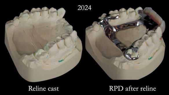 Newsletter 66 Long term case study. Life changing metal based RPD made for Anna