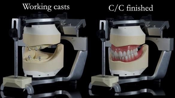 Newsletter 65 Marisa Provision of Complete Dentures on badly placed implants