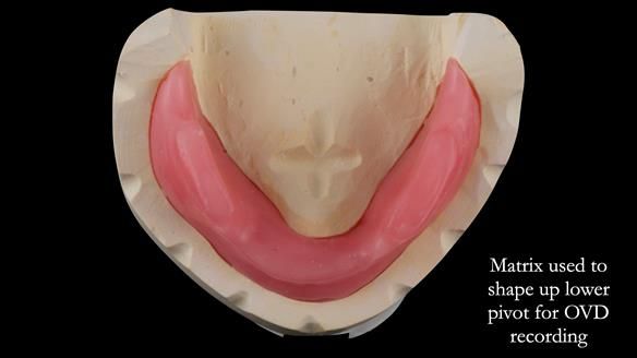 Replacing Madeline’s Complete denture FULL PROTOCOL