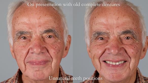 Newsletter 74: Ken’s Case Study Complete Dentures - Life Like and Age Appropriate