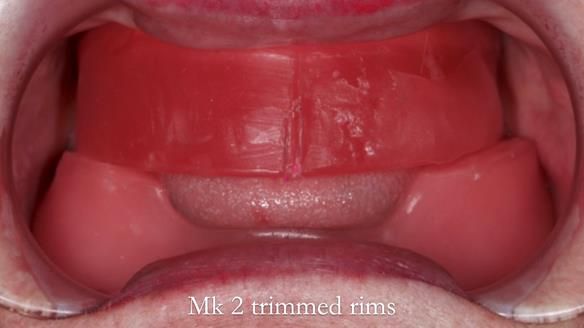 Replacing Madeline’s Complete denture FULL PROTOCOL