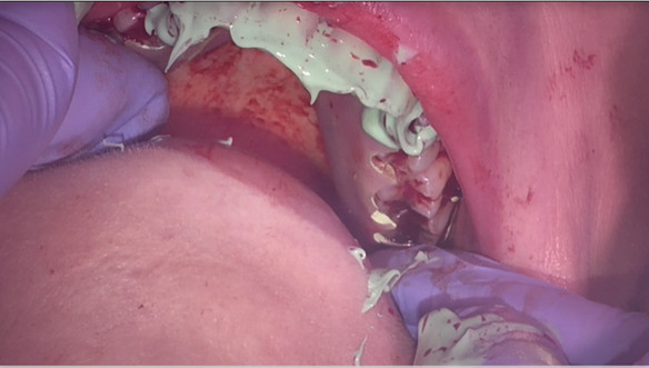  Figure 32 Seating the immediate denture to check the fit with light bodied silicone and Occlude spray