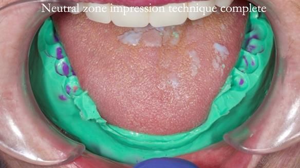 Replacing Madeline’s Complete denture FULL PROTOCOL