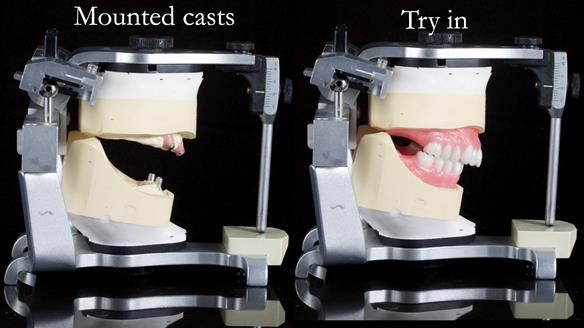 Newsletter 65 Marisa Provision of Complete Dentures on badly placed implants