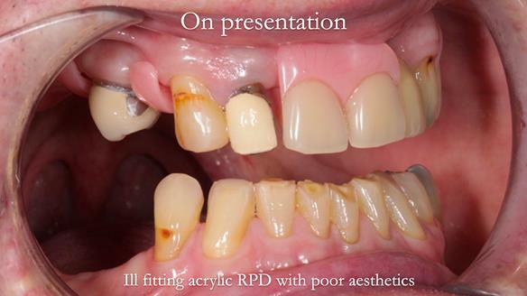 Managing Edgar “THE SCEPTIC” with an RPD/Splint FULL CASE