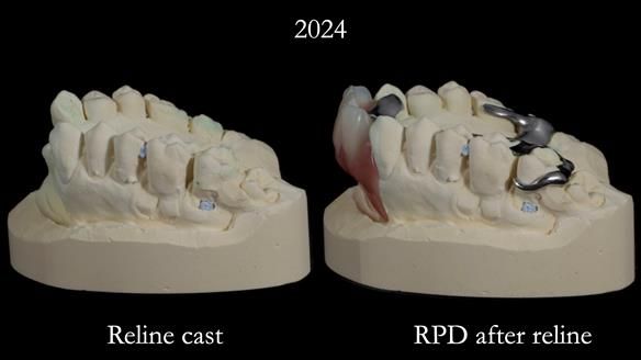 Newsletter 66 Long term case study. Life changing metal based RPD made for Anna