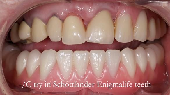 Newsletter 44 - extreme removable prosthodontics – engineering a super-strong and ultra-thin over denture