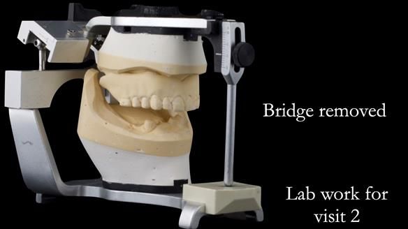 Newsletter 49 Managing Estelle’s failing implants with dentures FULL PROTOCOL